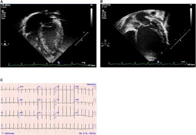 Familial Dilated Cardiomyopathy Associated With a Novel Combination of Compound Heterozygous TNNC1 Variants